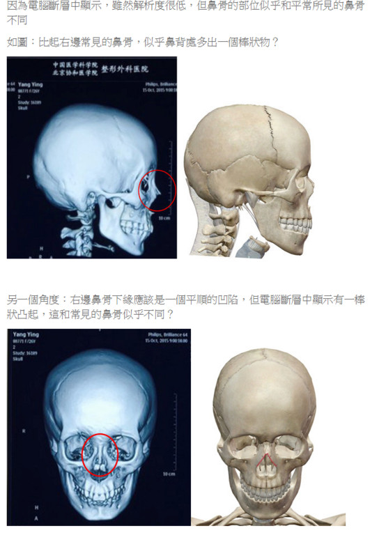 专家质疑baby面部鉴定结果：鼻骨有棒状物(组图)