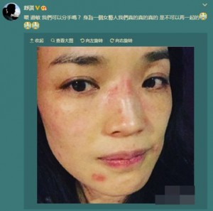 舒淇晒过敏照脸上出现红斑:做女艺人不能这样(图)