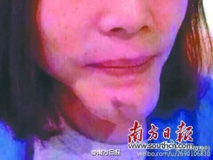 女子乱打"美容针"毁容  下巴长成"后脚跟"(图)