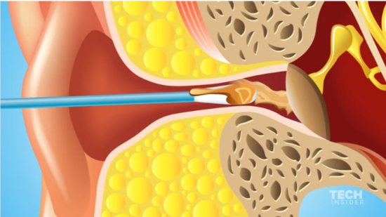 这种严重后果让你以后不敢"轻易用棉花棒掏耳朵”