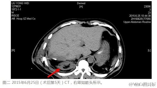 医院回应男子右肾失踪： 术后2次CT均显示其存在