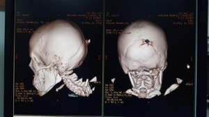 熊孩子甩飞刀扎女童脑袋 刀上刻"小李飞刀"(组图)