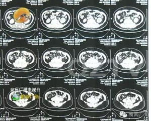 男子腹部隆起似"怀孕" 检查发现体内有4个肾(图)