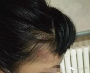 女生寝室遭7名女生轮扇耳光 嘴角撕裂缝30针(图)