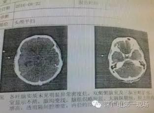 深圳男子玩水被罕见"吃脑虫"入侵  十几天后病逝