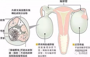 女子"怀孕"17年 腹中取出东西都有头发和牙了(图)